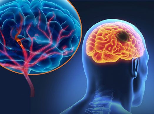 stroke Έρευνα: Οι στατίνες μειώνουν τον κίνδυνο εμφράγματος ή εγκεφαλικού