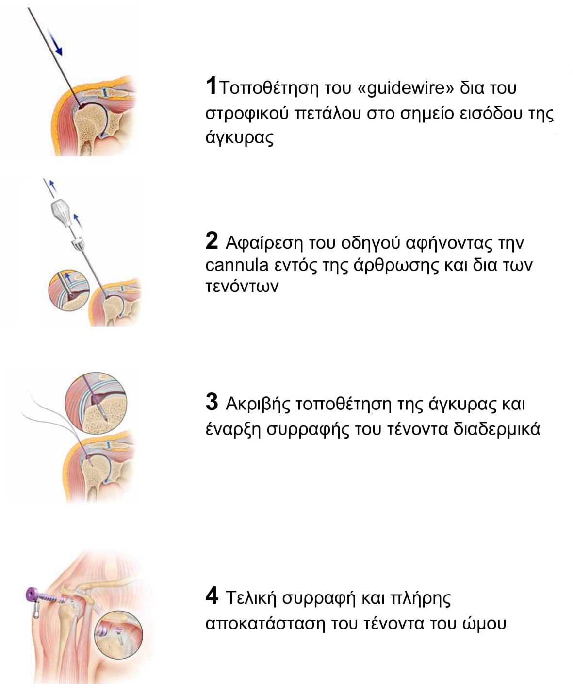 Τέλος στον πόνο λόγω ρήξης τενόντων του ώμου
